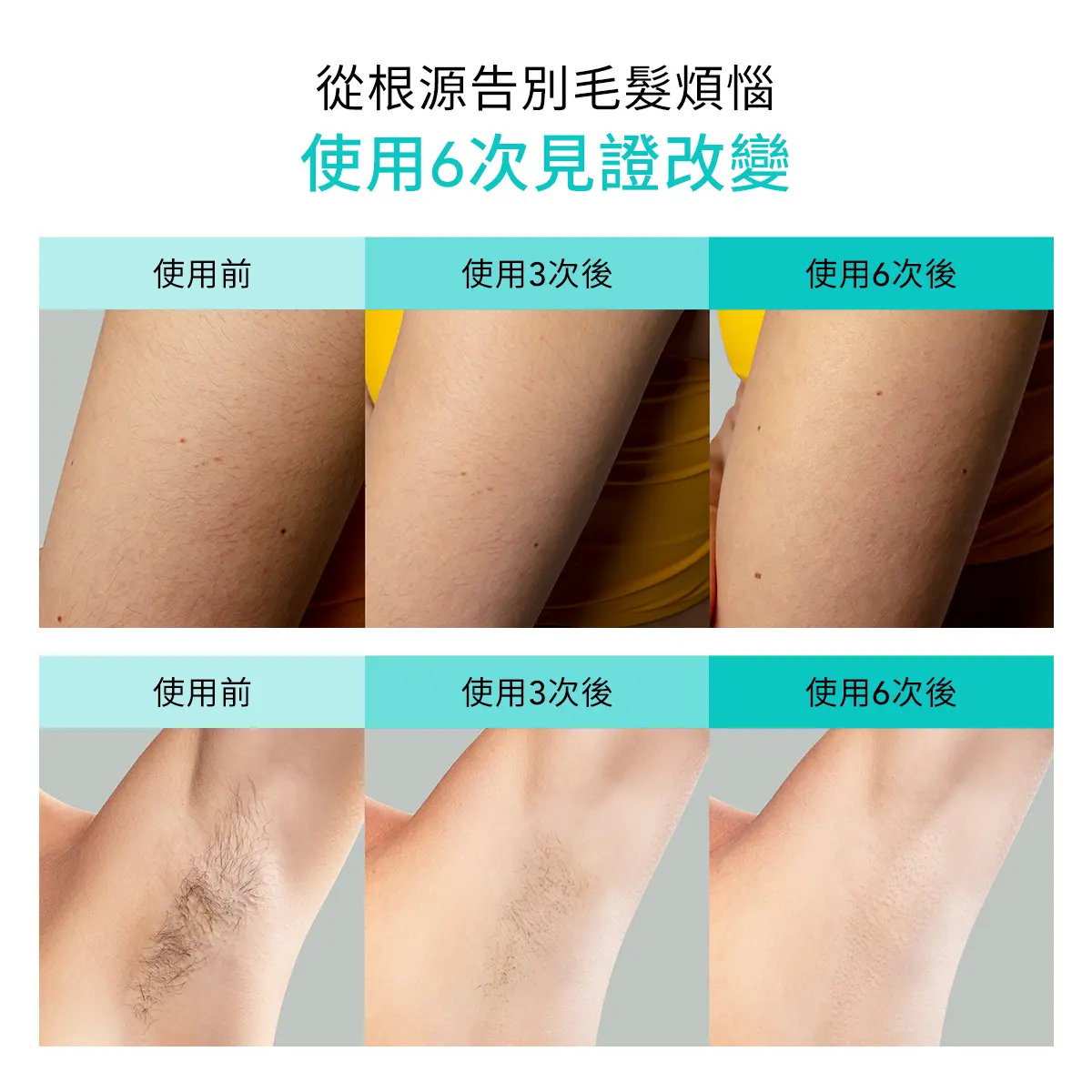 根源告別毛髮煩惱，使用6次見證改變。臨床實證4次使用，即可減少毛髮達90%；即使停止使用後毛髮數量、長度及密度顯著減少。