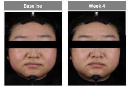 Oligihome Hydro Glow Mode 臨床測試圖:皮膚亮度 +1.57%,使用前與 4 星期後對比(SKINMED Clinical Trials Center)